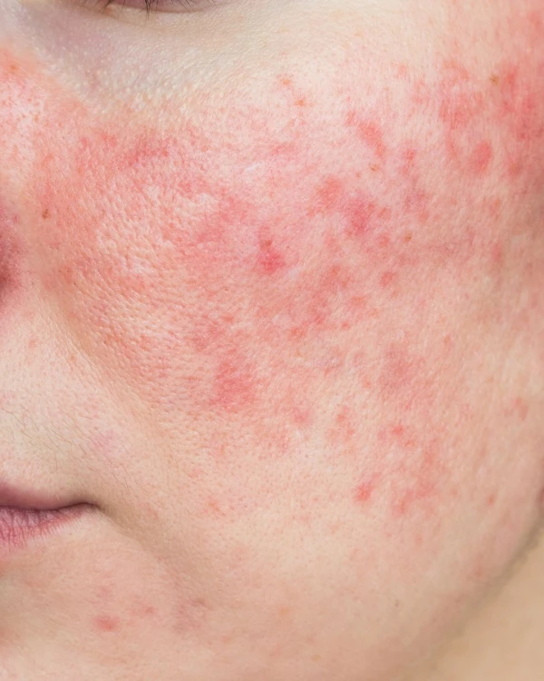 Wat is Rosacea en Hoe Kun Je Het Aanpakken?
