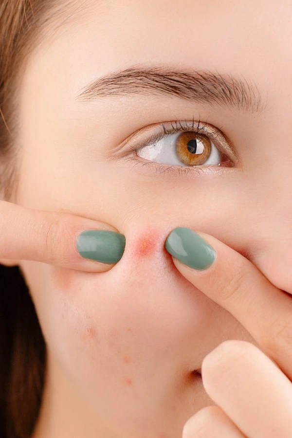 Fruitzuurpeeling bij acne: waarom een peeling dé aanpak is bij puistjes