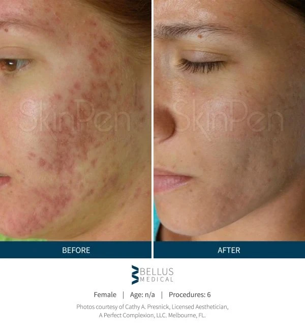 SkinPen microneedling resultaat voor en na behandeling van acnelittekens – W-Skincare Raamsdonksveer