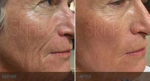 Voor en na resultaat SkinPen microneedling gezicht – anti-aging behandeling Raamsdonksveer