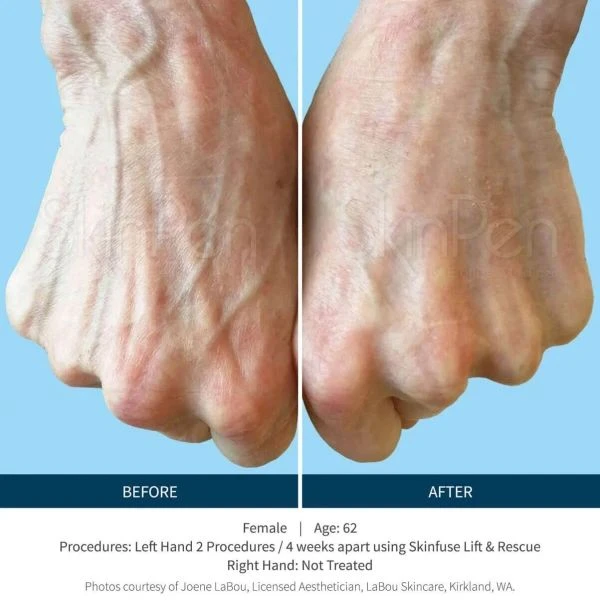 Voor en na resultaat SkinPen microneedling handen – anti-aging behandeling Raamsdonksveer