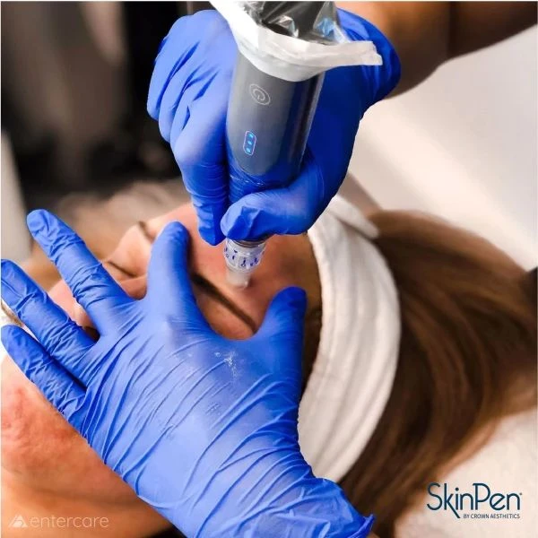 SkinPen microneedling behandeling van het gezicht bij W-Skincare in Raamsdonksveer