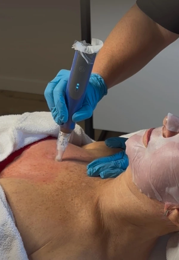 SkinPen® microneedling behandeling van het decolleté bij W-Skincare in Raamsdonksveer