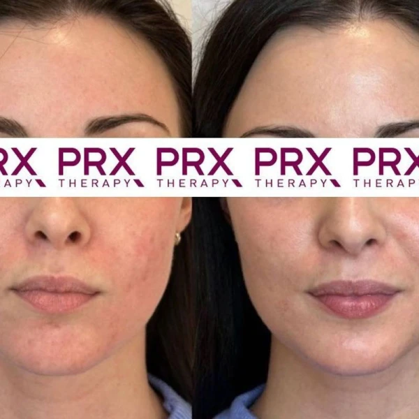 PRX-T33 skinbooster biorevitalisatie behandeling voor huidverbetering en collageenstimulatie