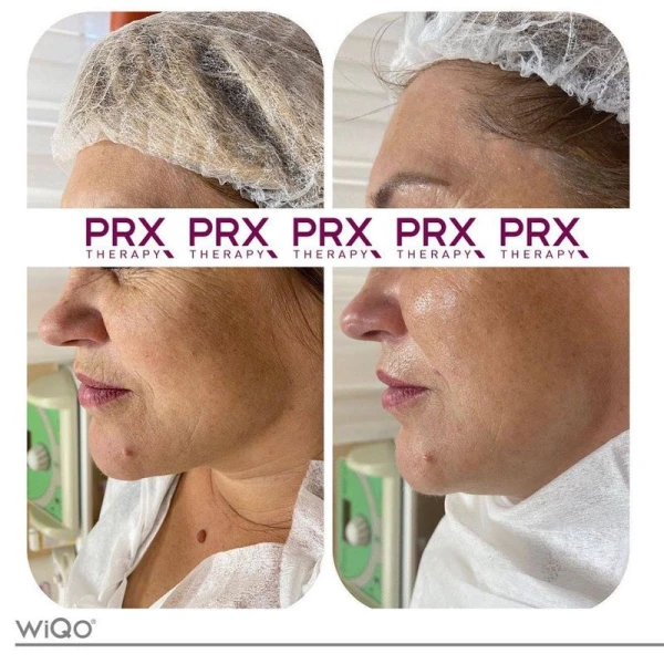 PRX-T33 Skinbooster voor huidveroudering verminderen – W-Skincare