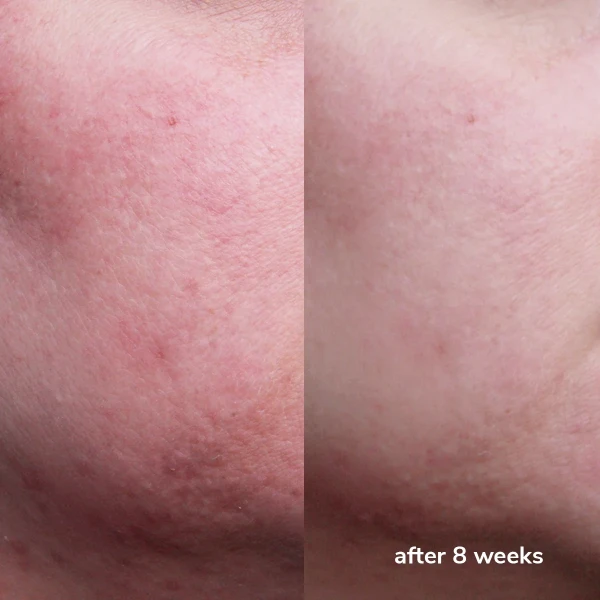 Signalneedling bij W-Skincare  Raamsdonksveer